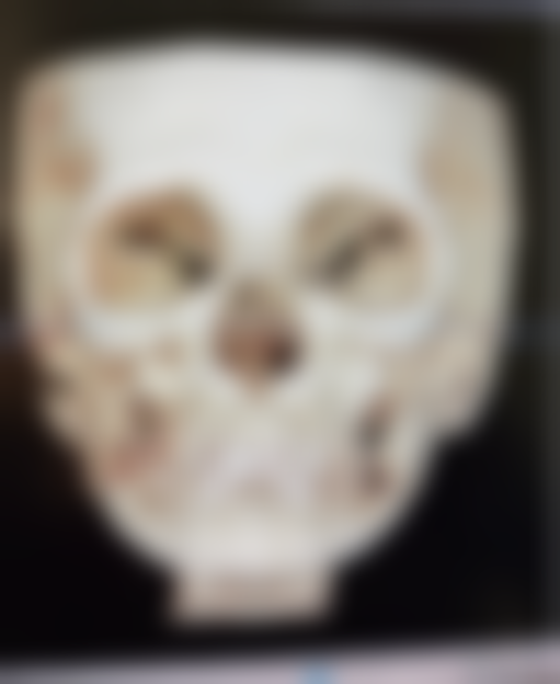 疤痕体质的疤痕去除难题怎么破？就医疗疗注意要点