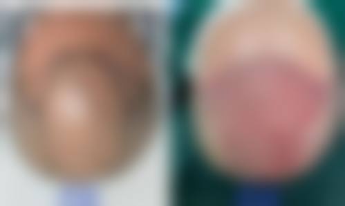 五、哈尔滨瑞丽诗植发医院实例