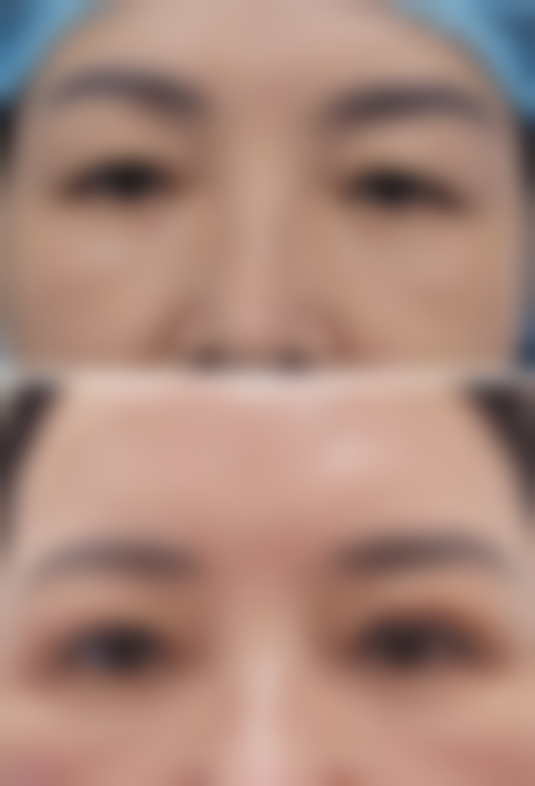 双眼皮术后疤痕增生别慌张，认清症状早应对