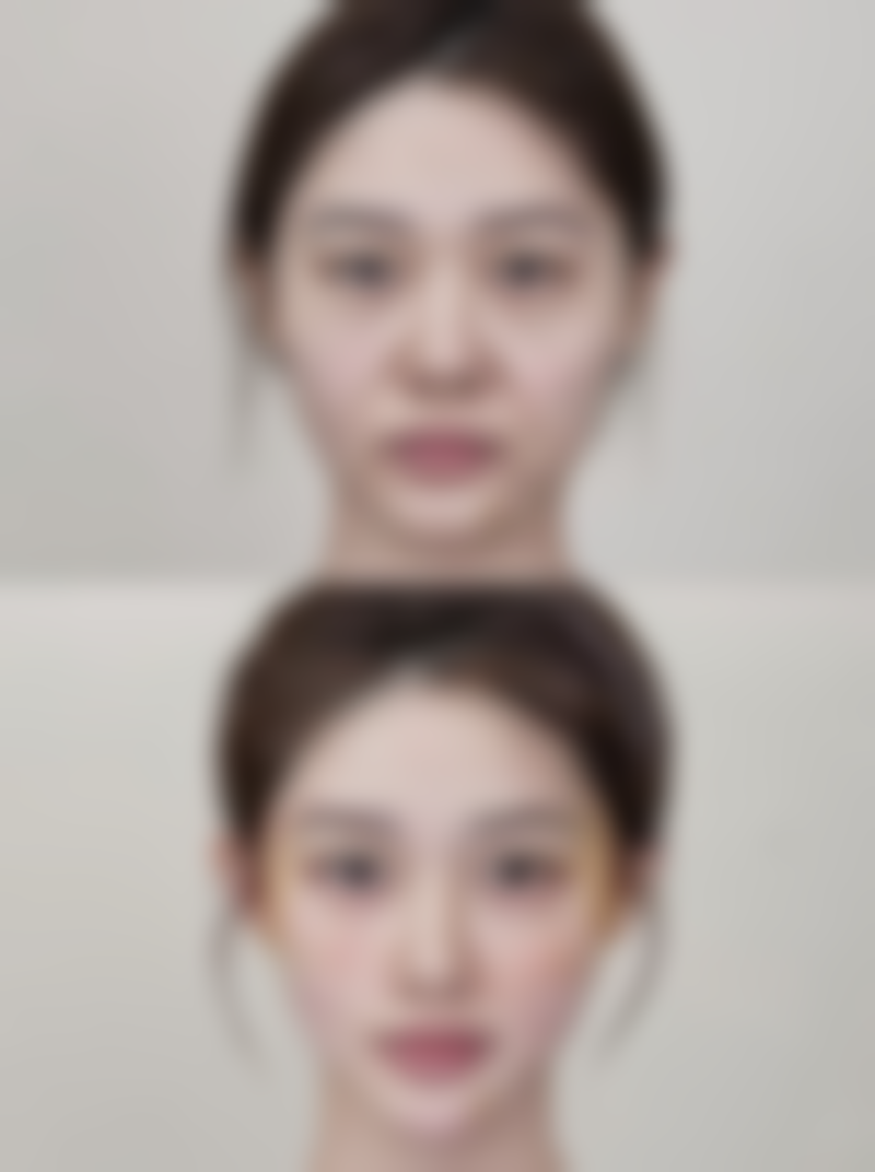 如何打造效果绝佳的双眼皮？综合考量多因素，匹配术式+精细护理成就自然美眼