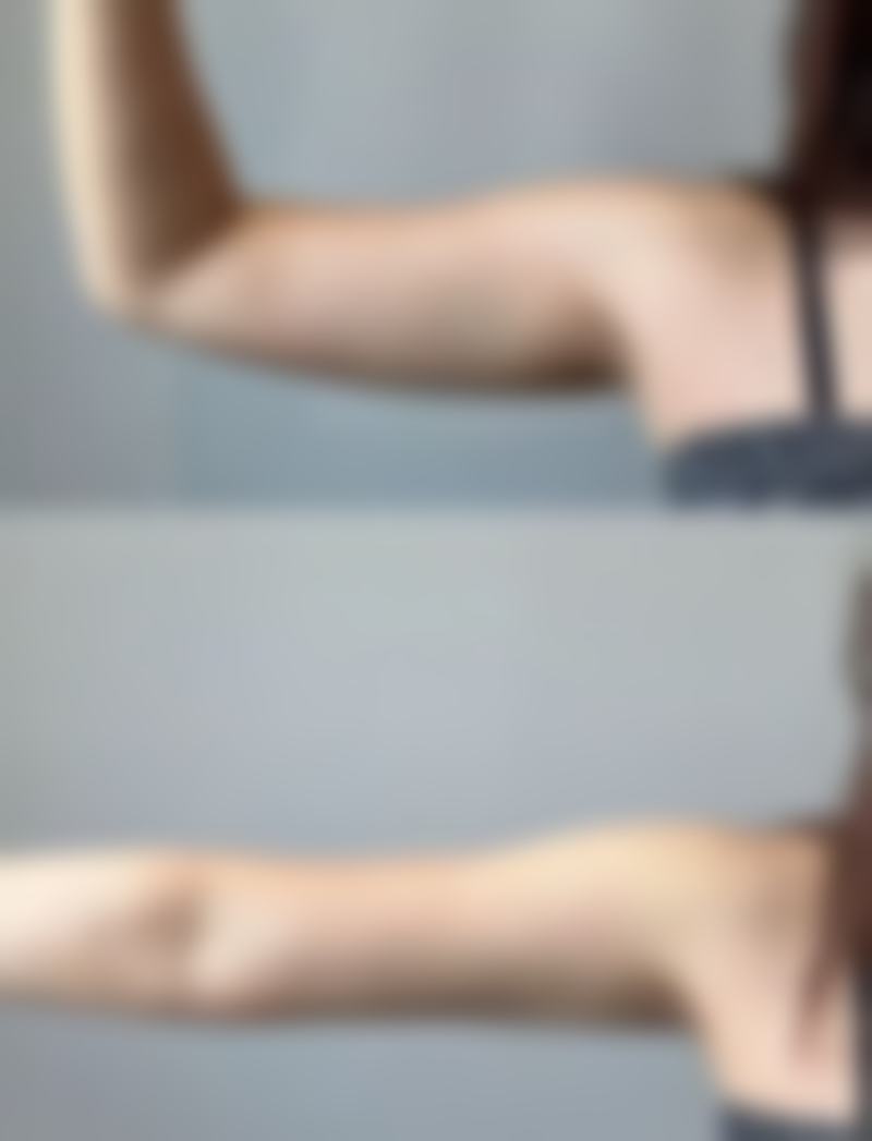 术后精细护理不能少，助力双眼皮理想呈现