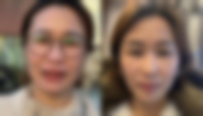 自然好看双眼皮的核心要求，条条要达标