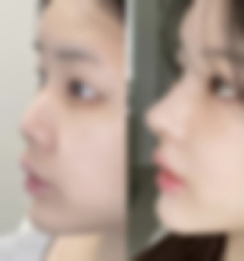 还在为眼袋烦？药物治疗有门道