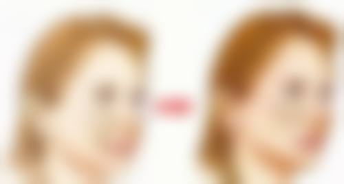 种植发际线多久能长起来？最快1个月见新发，1 - 18个月逐步达自然浓密效果 