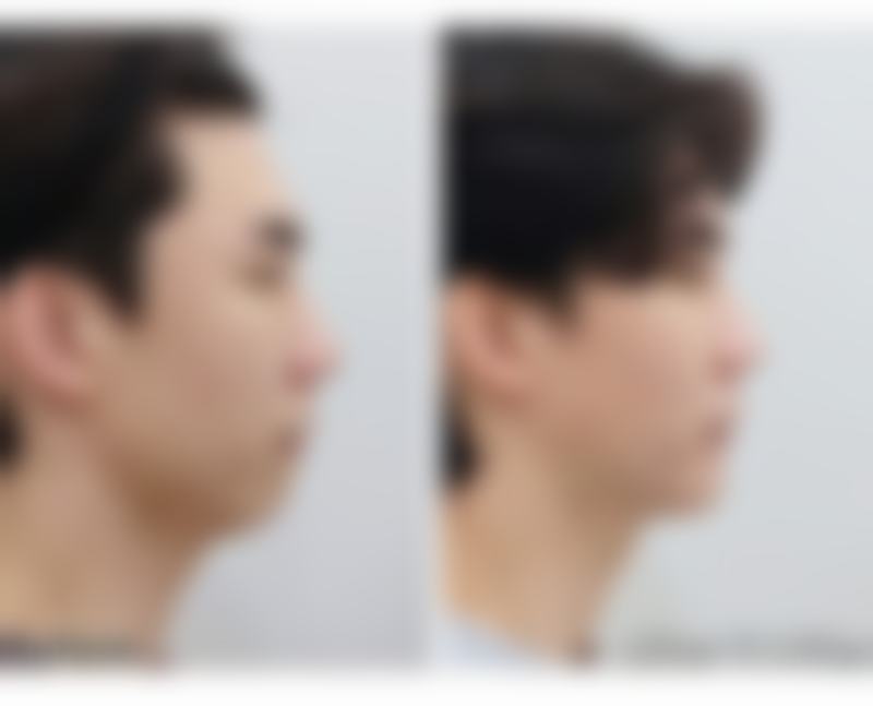 种植发际线多久能长起来？影响生长速度的因素