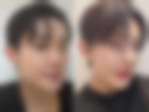 滴眼液能去除眼袋吗?配合习惯调整成效好