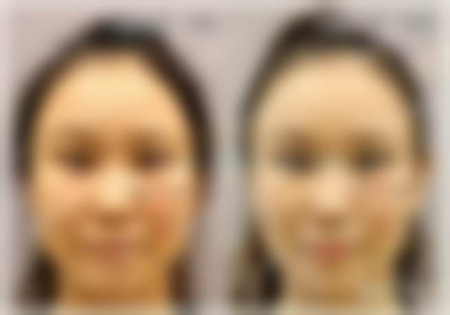 北京市张冰洁手术价格揭秘，双眼皮修复36000起，内眼角修复同样36000起 