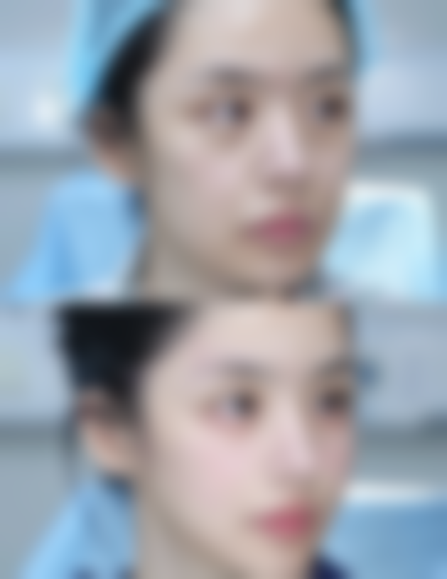 双眼皮割窄了不用怕，多样修复方法任你选