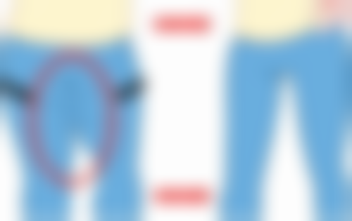 假体隆胸喂奶究竟会不会下垂？假体相关因素不可忽视