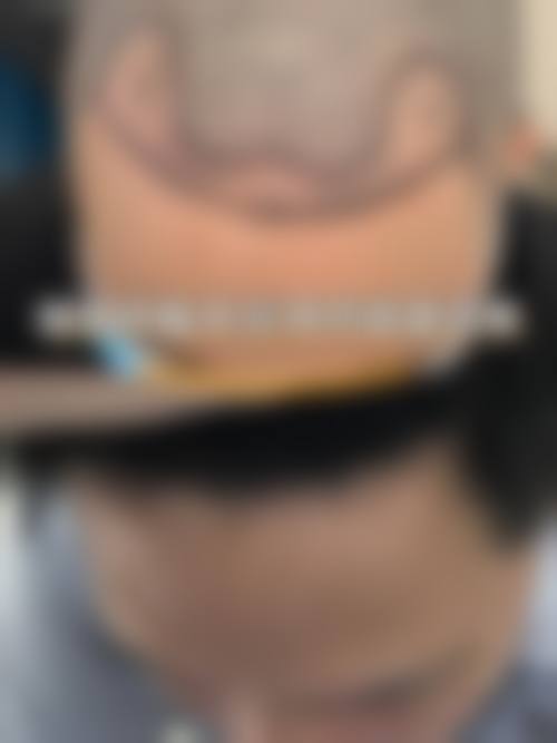 六、庆阳沐森植发医院怎么预约：