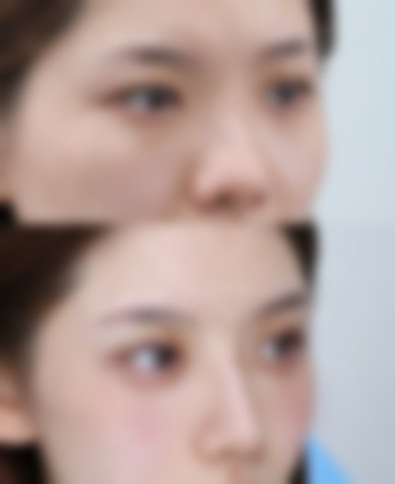 甲状腺手术疤痕增生的药物干预