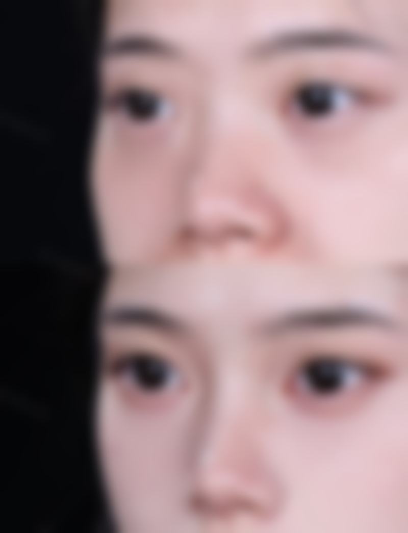 肋骨隆鼻真能终身有效吗？技术保护是关键