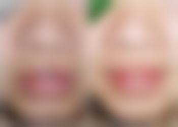 哪种双眼皮手术强？微创双眼皮的独特魅力