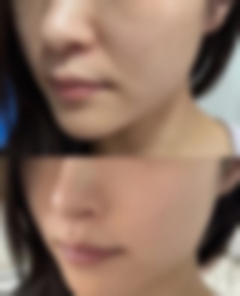 哪种双眼皮手术比较好？剖析埋线、全切等术式优势，让你美得自然又持久 