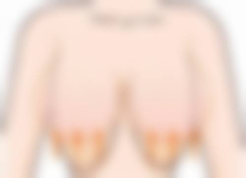 割双眼皮后修复，术后护理要点需牢记