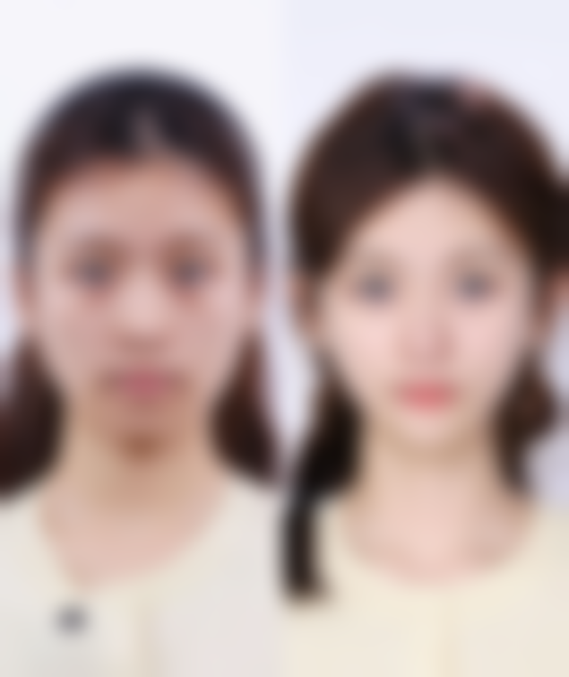 有哪些专项吸脂技术?各技术优势大揭秘