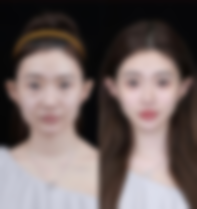 一个双眼皮一个三眼皮诱因大揭秘：疾病与外伤因素