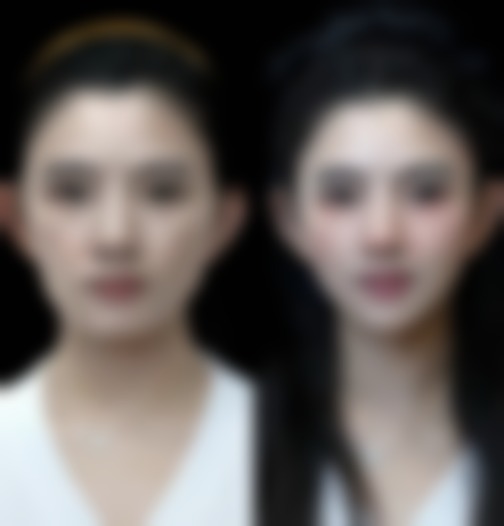 一个双眼皮一个三眼皮诱因大揭秘：年龄相关因素