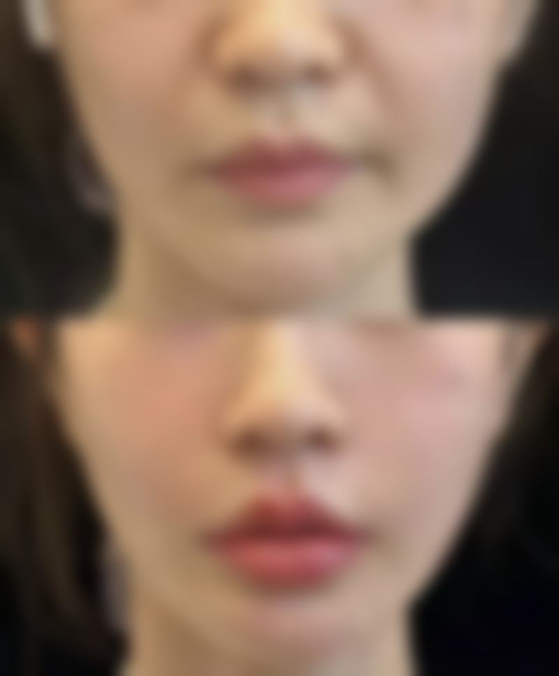 一个双眼皮一个三眼皮处理方式大揭秘：医学干预手段