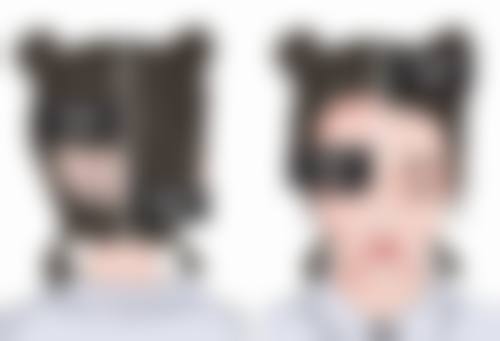 祛斑留下的疤痕怎么修复？物理治疗显神通