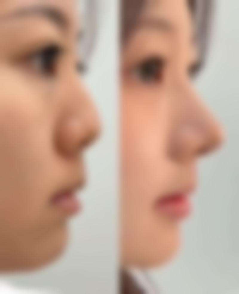 祛斑留下的疤痕怎样才能去掉？揭秘高效修复秘诀，快速淡化疤痕恢复肌肤光滑