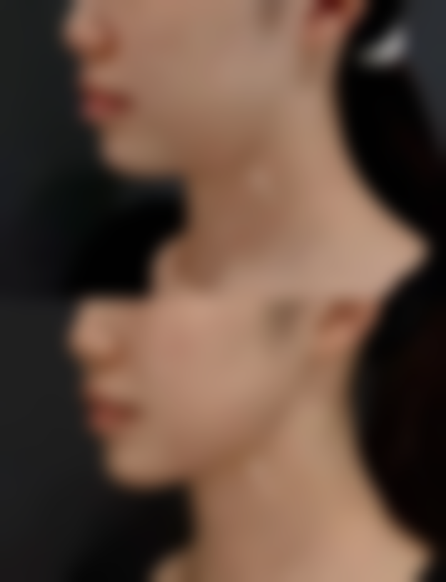 祛斑留下的疤痕如何快速去掉？保持良好心态特别重要