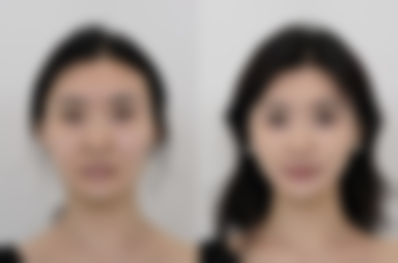 割了双眼皮肿得厉害，生活护理调整特别重要