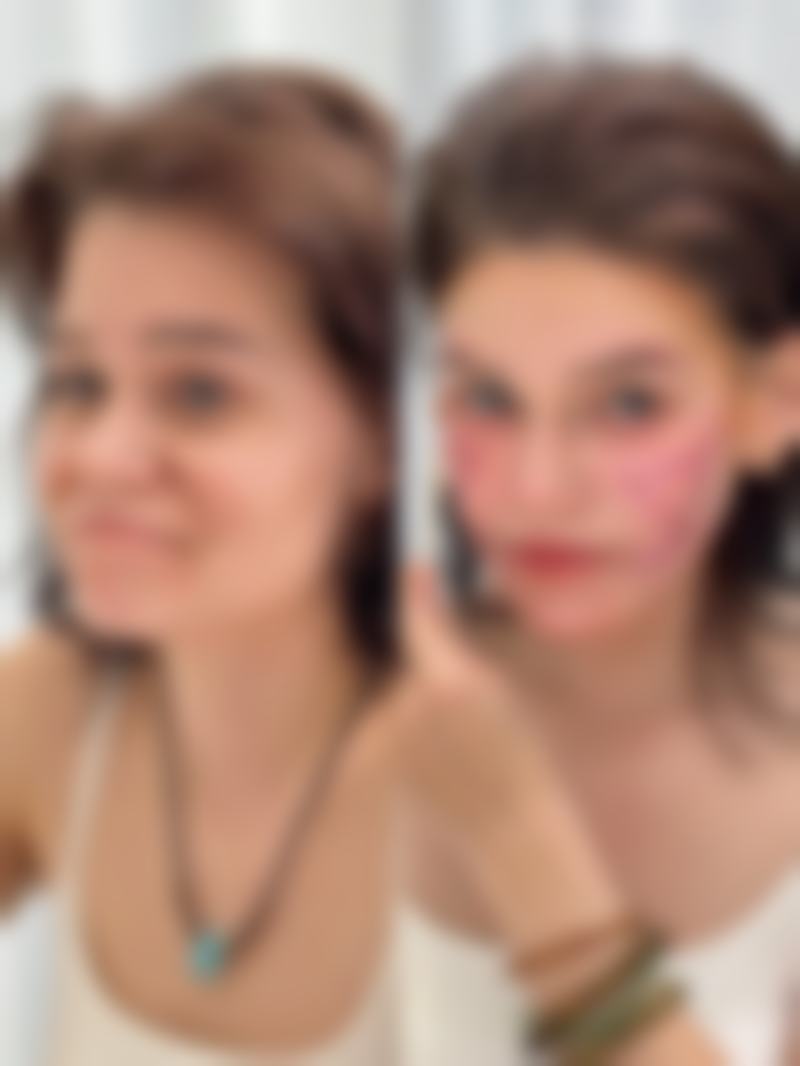 手术伤口疤痕增生怎么治？光电激光有妙招，针对性改善外观