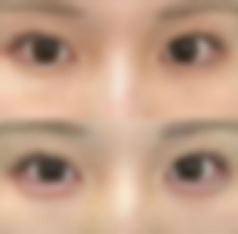 手术伤口疤痕增生怎么治？多种疗法结合，从根源改善疤痕质地与外观 