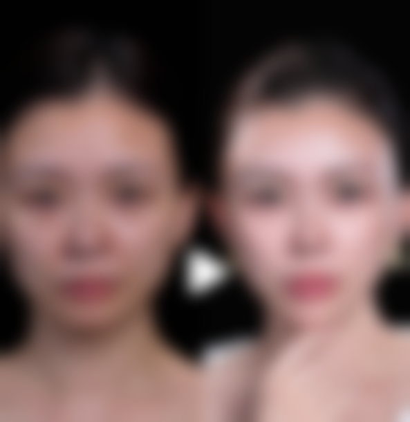 做双眼皮抽脂的价格参考