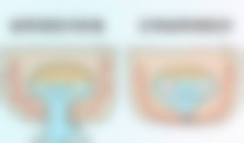 瘦下来后眼袋突显，医美/手术治疗显成效