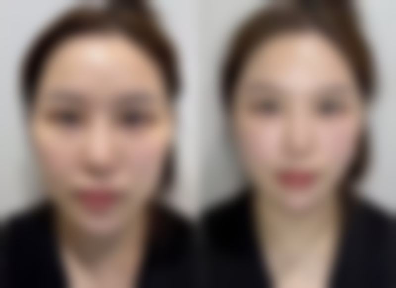 手术修复：注意事项不可少