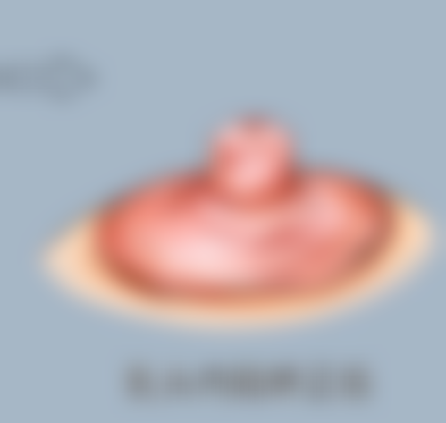 怎样快速让双眼皮消肿？物理、药物、饮食多管齐下，全方位助力恢复！ 