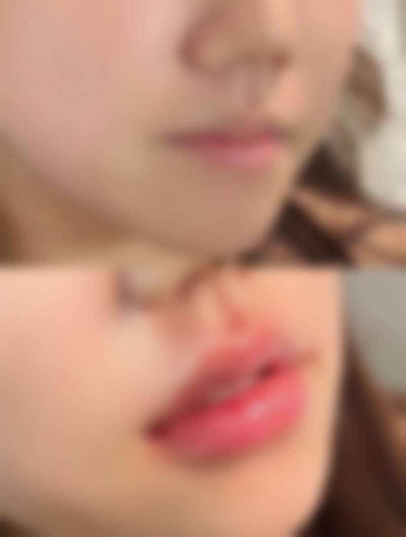 怎样快速让双眼皮消肿？伤口与日常护理不可少