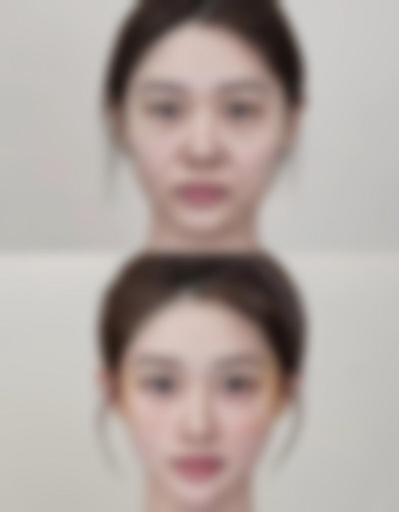 如何破解疤痕体质难题？多种治疗与预防护理结合，淡化改善瘢痕效果佳 