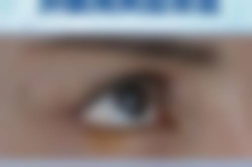 瘢痕体质做埋线双眼皮术前要做哪些准备？