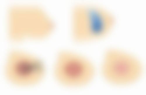 孩子手术留疤当兵：不同兵种的要求差异