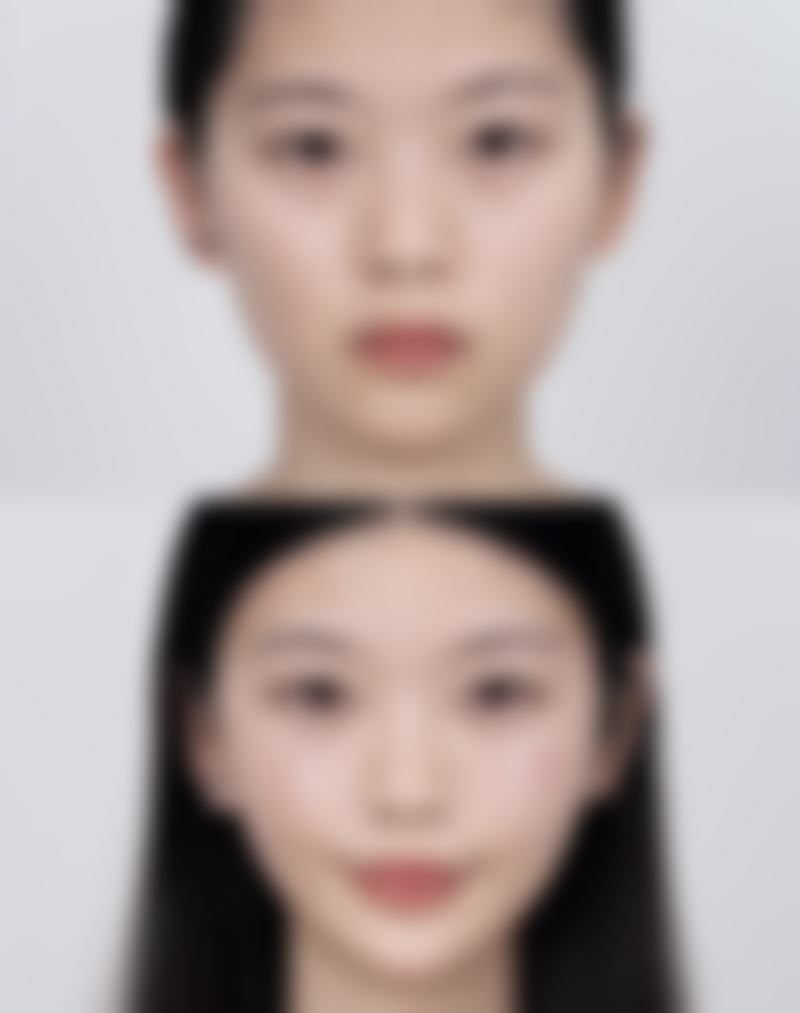 做完双眼皮能冰敷吗？冰敷正确操作规范要掌握