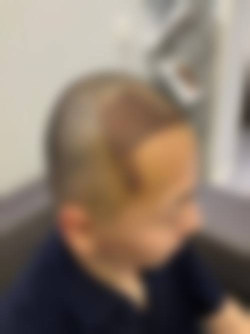 七、韩国永长（Woomchan）毛发移植医院价格表：（仅供参考）