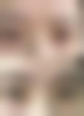 如何简单快速除眼袋？医学美容非手术方案多