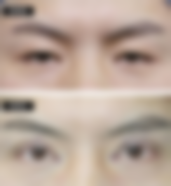 维生素E去眼袋的使用方法有哪些？多种方式任你选