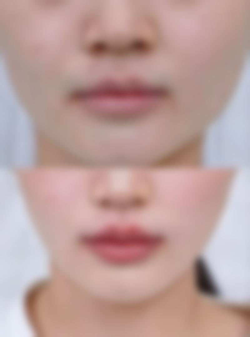 改善眼皮松弛的生活护理与基础干预：从日常做起