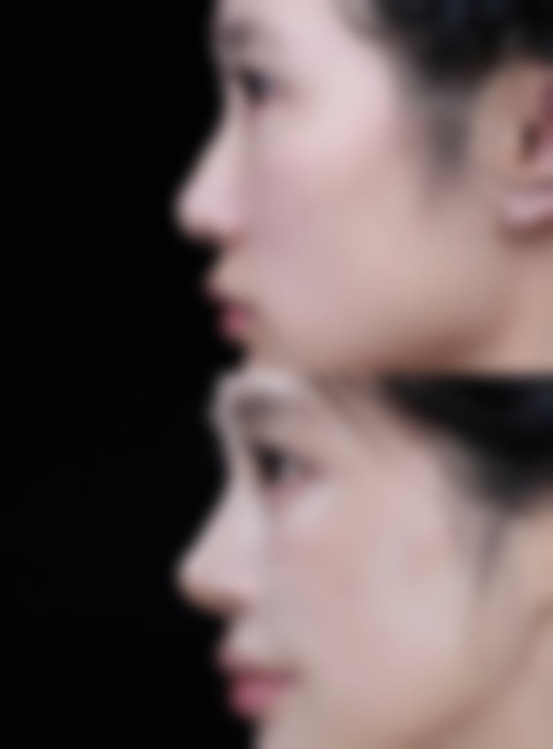 身上黑色疤痕去除妙招之物理治疗显神通