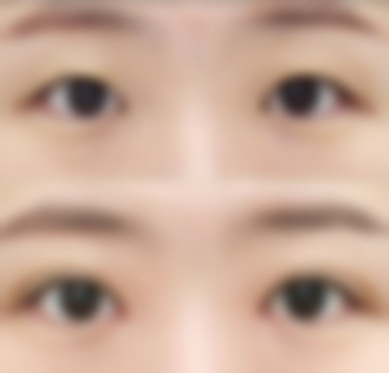 上眼皮厚肿眼泡适合做啥双眼皮？全切、Park及改良术式打造自然美观双眸 