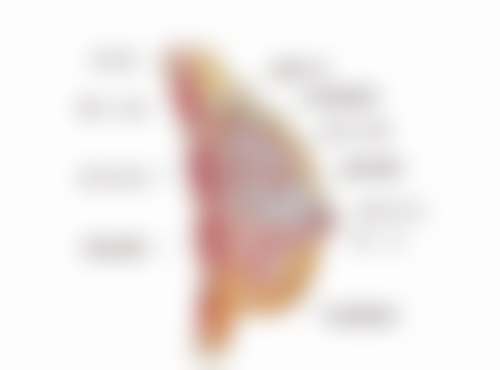 假体隆胸后外扩如何修复？多种非手术与手术方法，有效改善外扩重塑胸型 