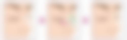 吸脂后何时开启射频紧肤？不同场景精准时间揭秘，促进愈合紧致肌肤增强效果 