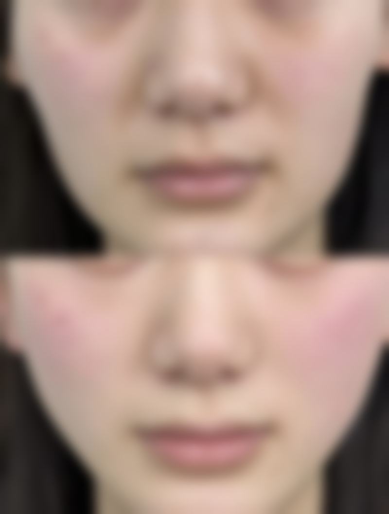 甲状腺手术疤痕怎么遮？装饰衣物道具齐上阵，无痕手术还能颈部零疤痕！ 