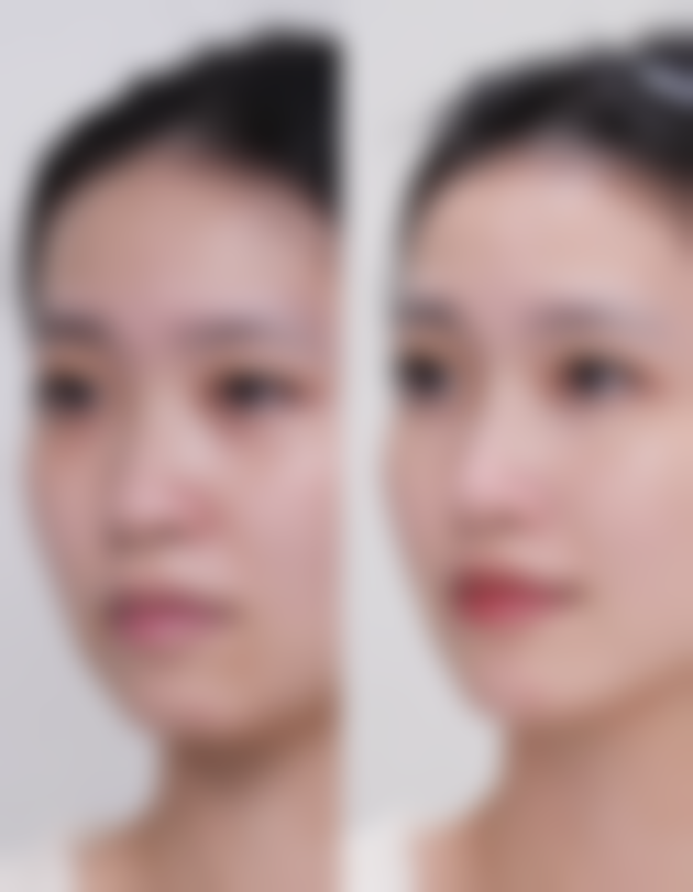 揭秘！皮肤干燥——水分流失造成的眼部困扰