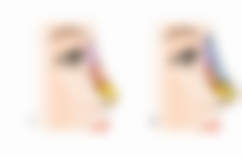 超声乳化吸脂究竟好不好？创伤小恢复快，还能精准塑形与紧致肌肤！ 