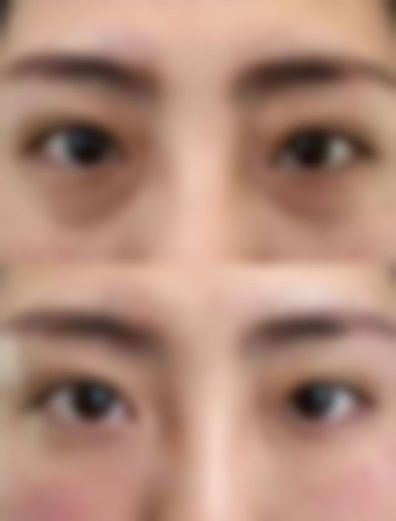 打完瘦脸针晚上怎么睡？睡眠配套护理不能忘